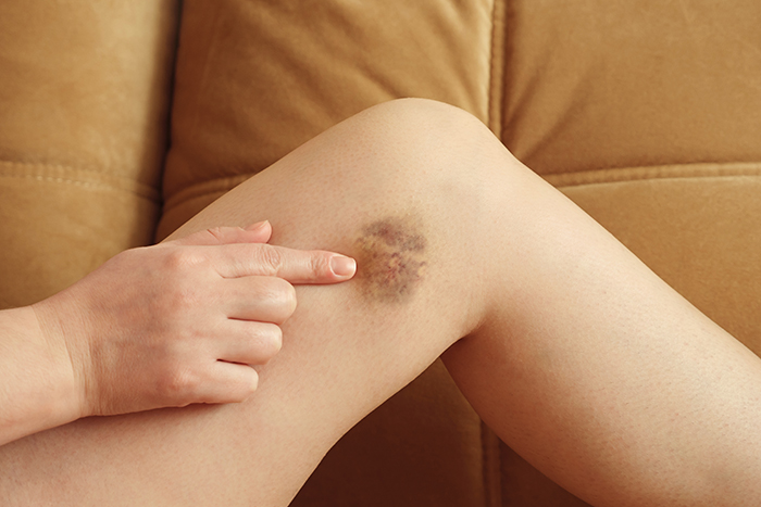 Woman points to a bruise on her leg against the couch