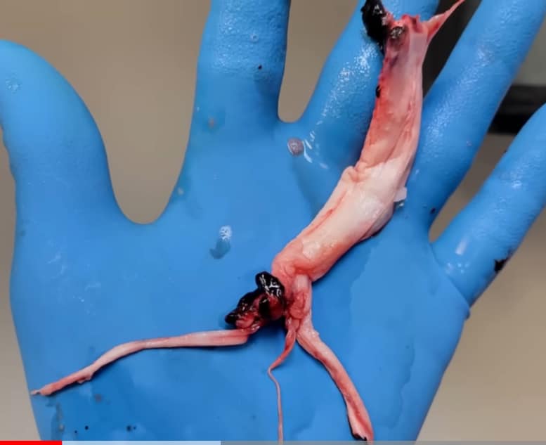 หมอธีระวัฒน์ พบแท่งย้วยสีขาว ในหลอดเลือดคนที่ฉีด วัคซีน mRNA