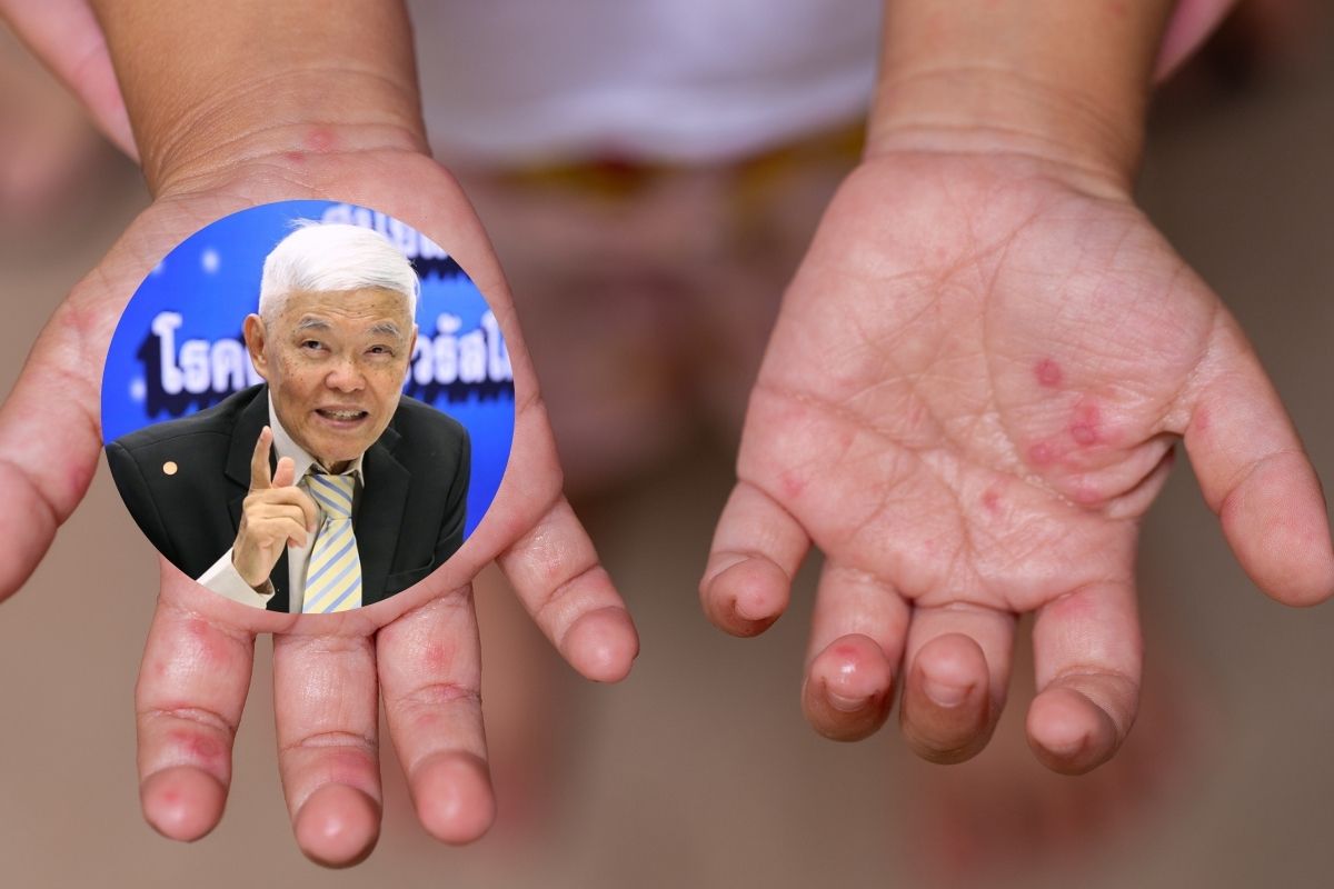 หมอยงเตือน หลังเปิดเทอมโรคมือ เท้า ปาก มีแนวโน้มระบาดเพิ่ม