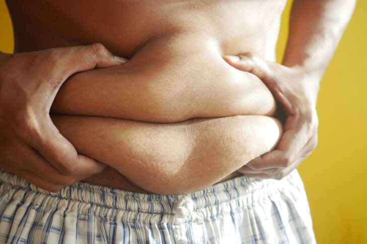 Obesity_001 Obesity