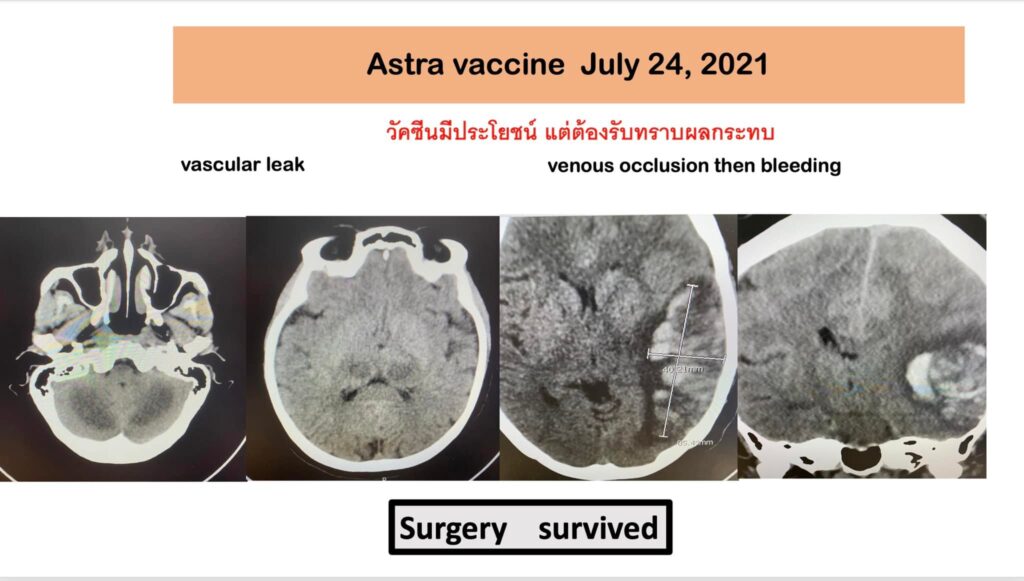 หมอธีระวัฒน์ เผยไทยยังฉีดแอสตร้าฯ จี้ชดใช้ค่าเสียหาย เยียวยา