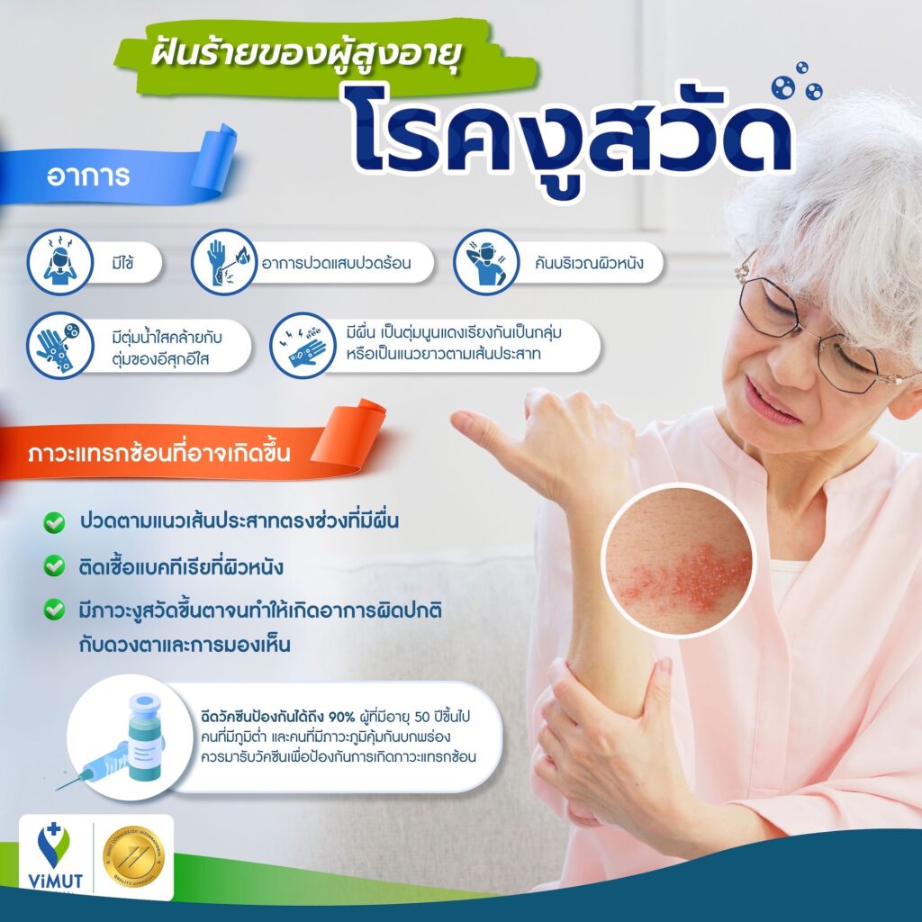 โรคงูสวัด