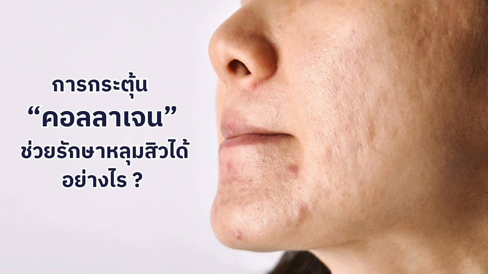 บอกลาปัญหาหลุมสิว ด้วยเทคโนโลยีกระตุ้นคอลลาเจนที่ EY Clinic