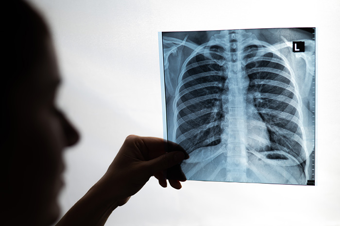 Doctor showing x-ray of patient's lungs.